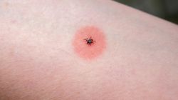 W tych regionach jest najwięcej kleszczy. Ukąszenie może wywołać alergię na mięso