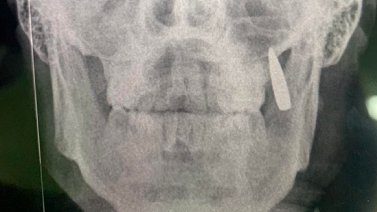 Nabój utkwił w szczęce żołnierza.