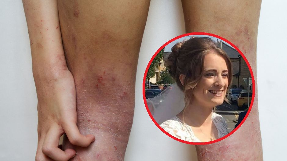 Wysypka była objawem rzadkiej i ciężkiej choroby