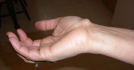 Ganglion – mało estetyczna, ale nieszkodliwa narośl na dłoniach i stopach