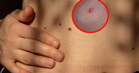 Zauważyłeś na skórze? Znamię Suttona może być groźne