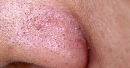 Nałóż na nos i poczekaj kwadrans. Wyciągnie wągry jak "odkurzacz"