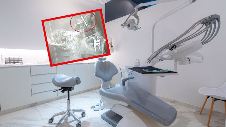 Dentysta wszczepił implant do mózgu pacjenta