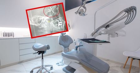 Chirurg w Turcji wbił implant dentystyczny aż do jamy mózgu pacjenta. Potem uciekł