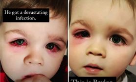 Chłopiec trafił do szpitala w krwisto czerwonymi oczami. Bawił się gumową zabawką do kąpieli