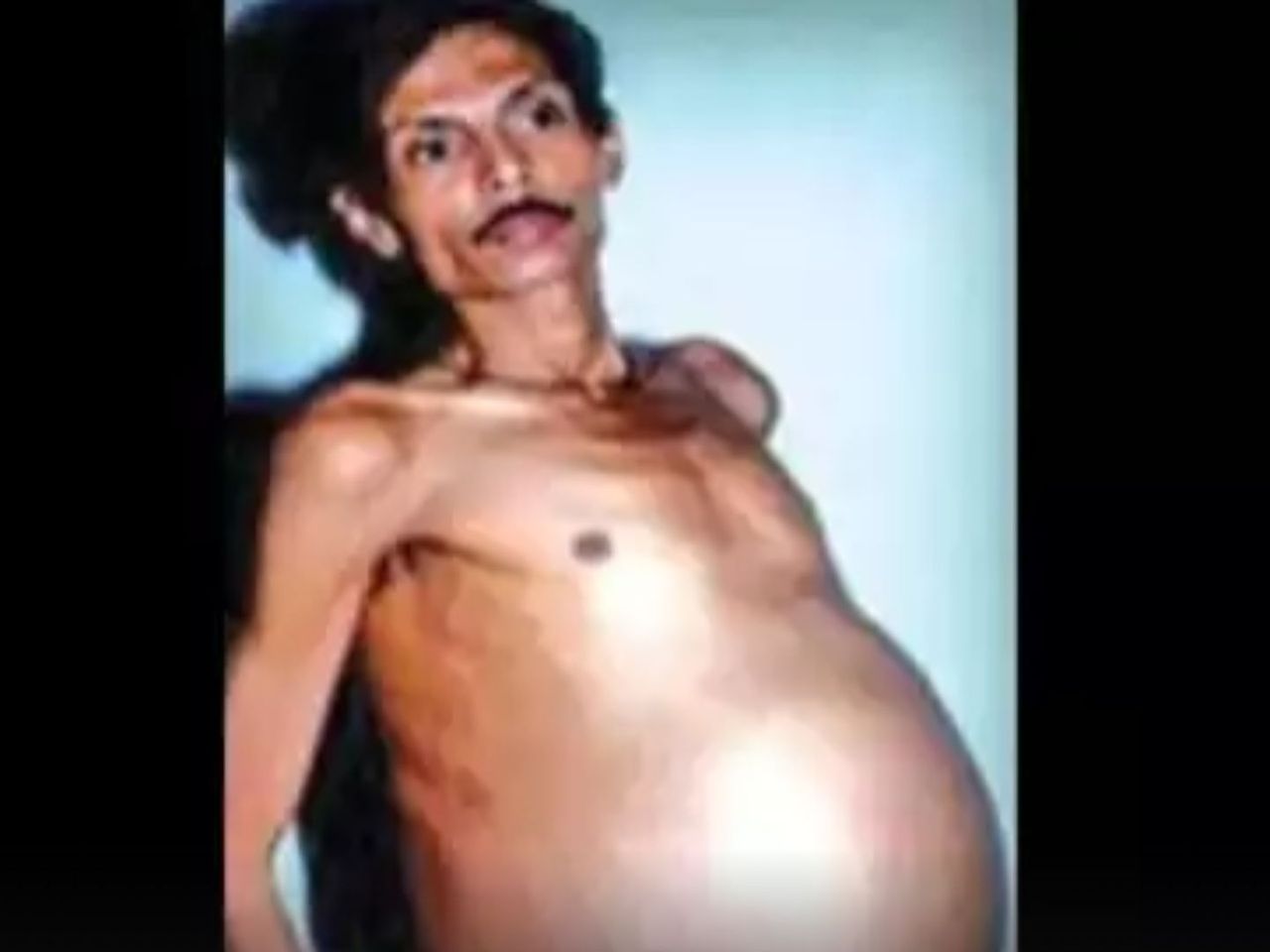 Niesamowity przypadek medyczny. Przez 36 lat nosił w sobie bliźniaka