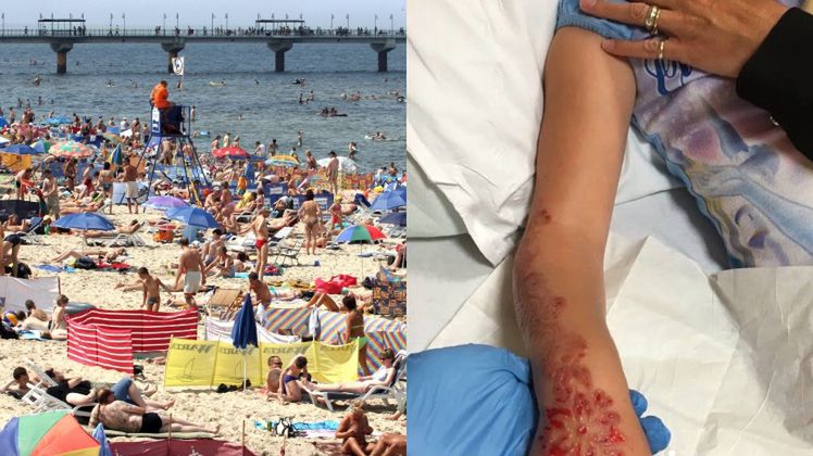 Dziecku spuchła ręka, bo namówiła mamę na tatuaż z henny