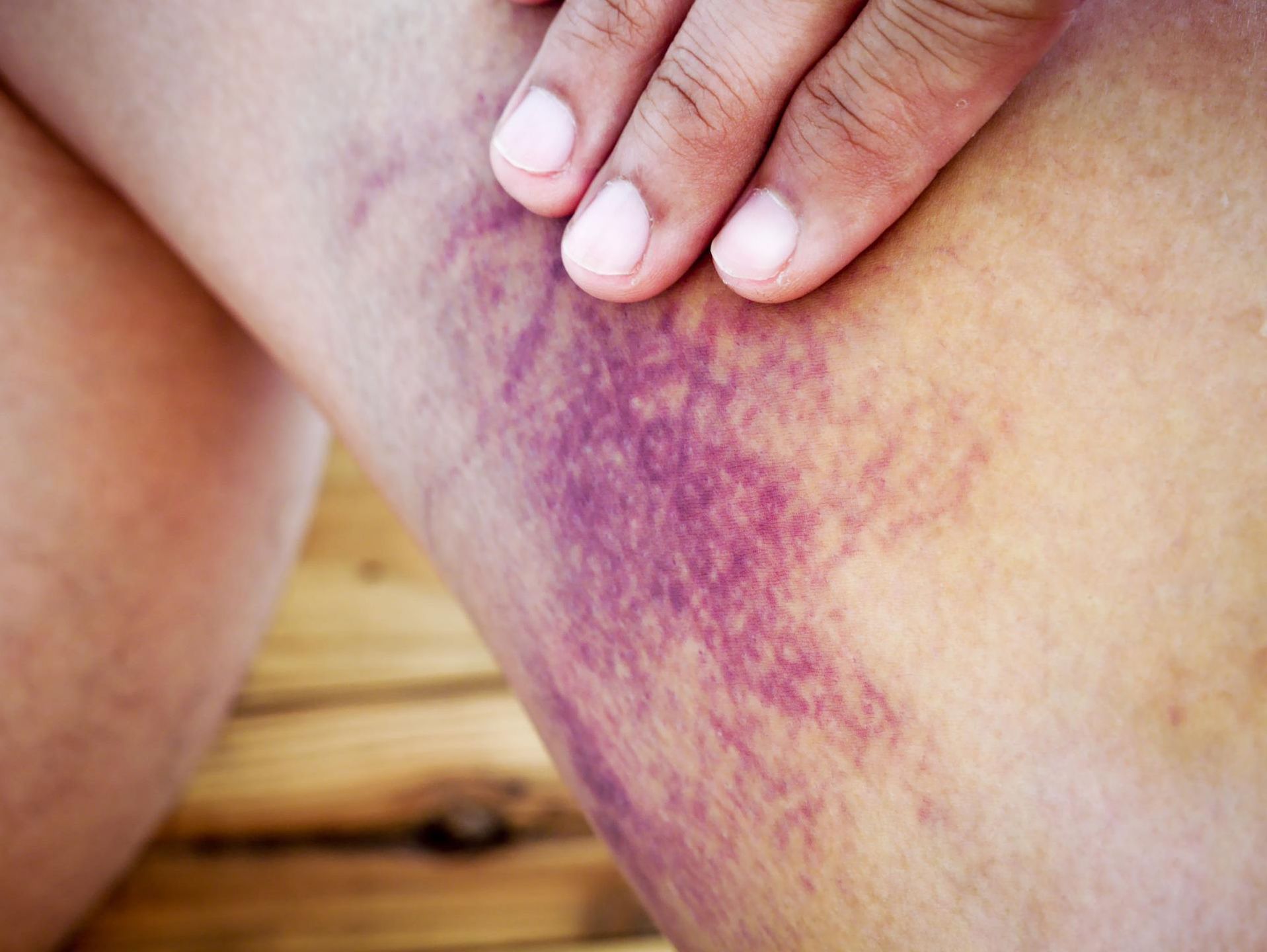 Siniaki na nogach mogą pojawić się z wielu przyczyn