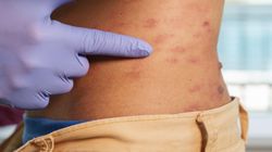 Zwiększa ryzyko udaru i zawału. Jest groźny nawet po wyzdrowieniu