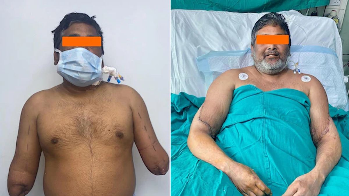 Mężczyźnie przeszczepiono obie ręce