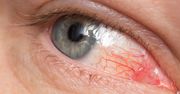 Jakie są najczęstsze przyczyny zapalenia rogówki?