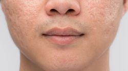 Izotretynoina - wskazania, działanie, bezpieczeństwo, fakty i mity