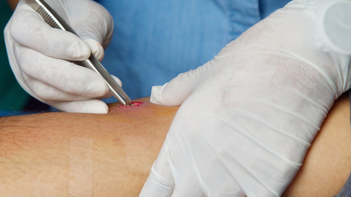 Ropnie leczy się operacyjnie – nacina się je i zakłada sączki, by oczyścić z ropy.