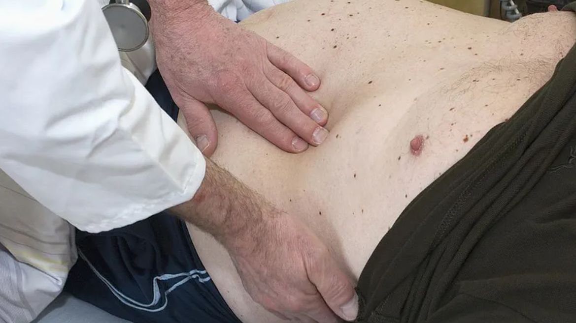 Jakie objawy daje rak jelita grubego?