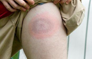 Tylko w maju wykryto 3 tys. przypadków boreliozy. Eksperci apelują o ostrożność