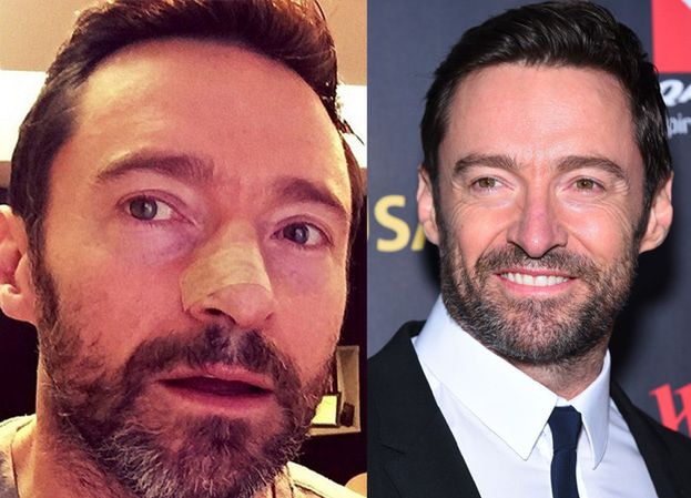 Hugh Jackman po raz PIĄTY usunął zmianę nowotworową z nosa! 