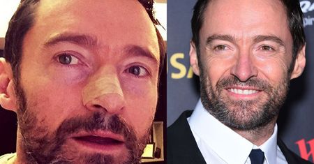 Hugh Jackman po raz PIĄTY usunął zmianę nowotworową z nosa!