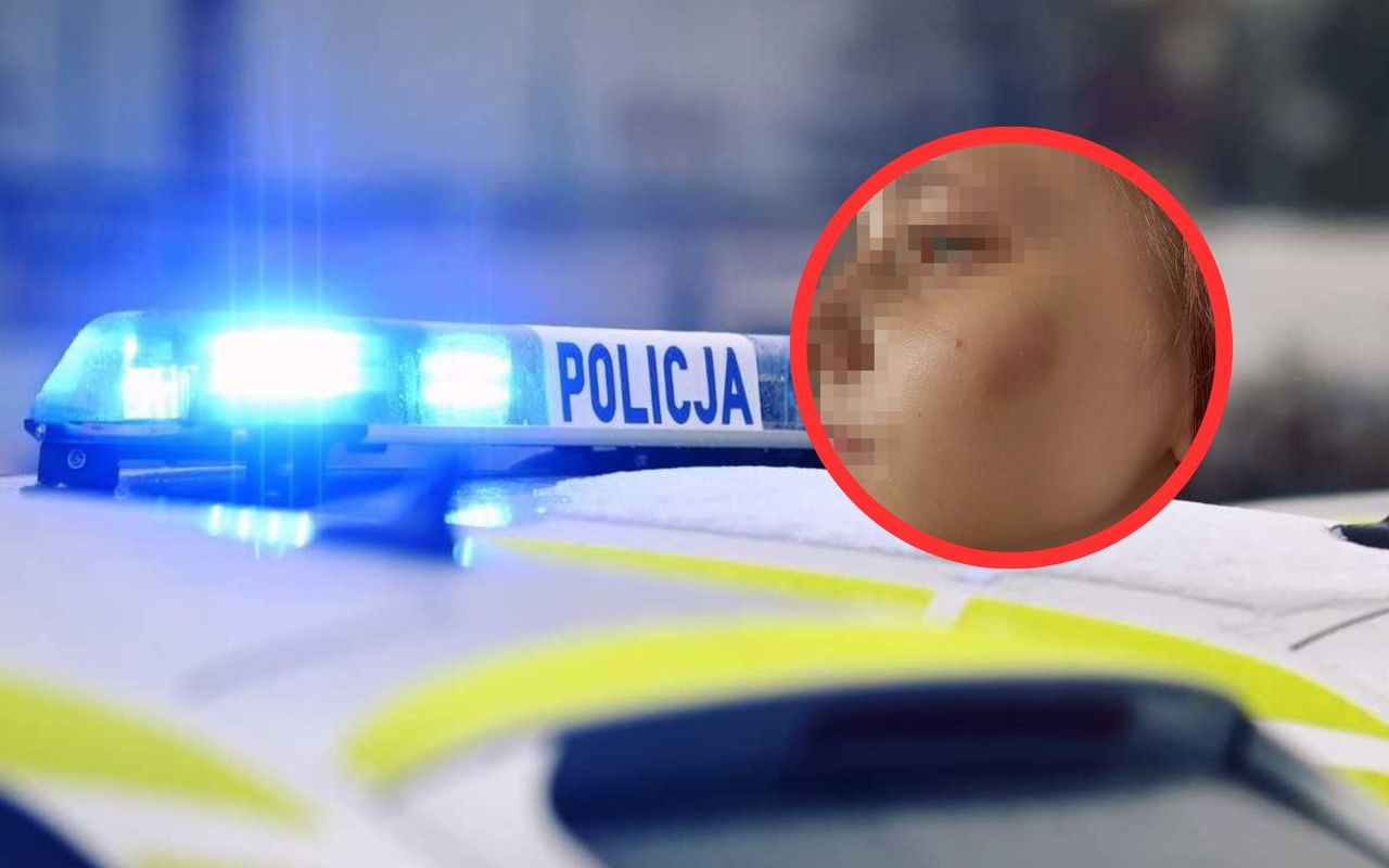 Dzieci z Ukrainy pobite w Legnicy? Pokazała zdjęcia córki