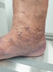 Zmiany naczyniowe przy kostkach z reguły świadczą o niewydolności żylnej