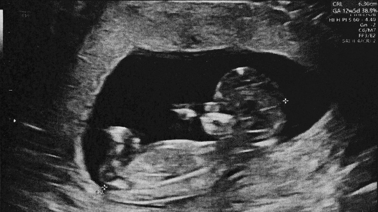 Ultrasound image of a pregnant woman