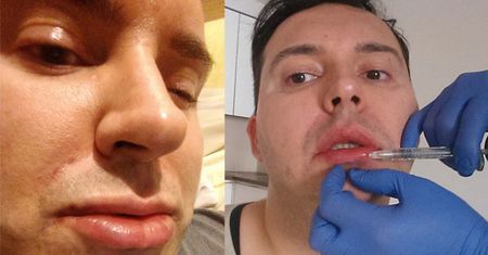 Witkowski WSTRZYKUJE SOBIE BOTOKS i powiększa usta! (ZDJĘCIA)