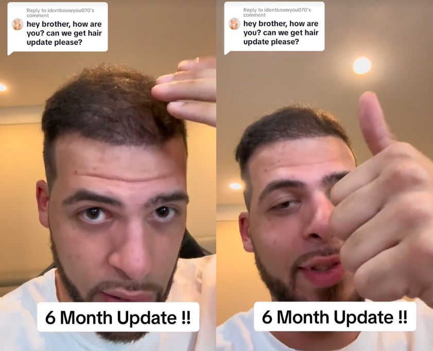 Przeszczepił włosy w Turcji. Oto jego historia