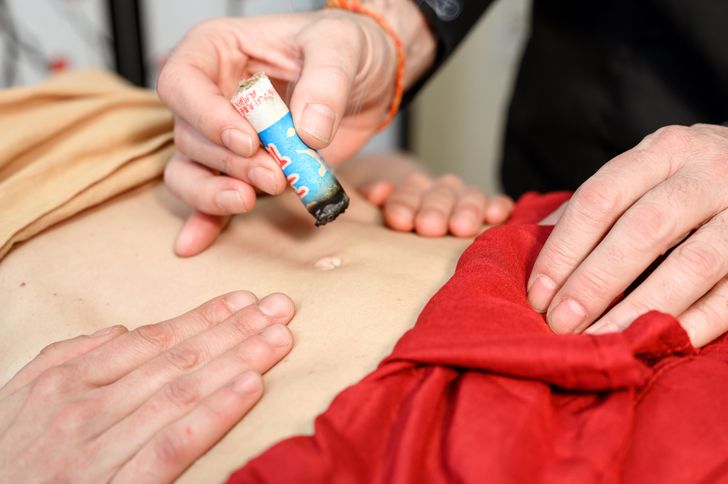 Co to jest moksoterapia? Na czym polega moksa?