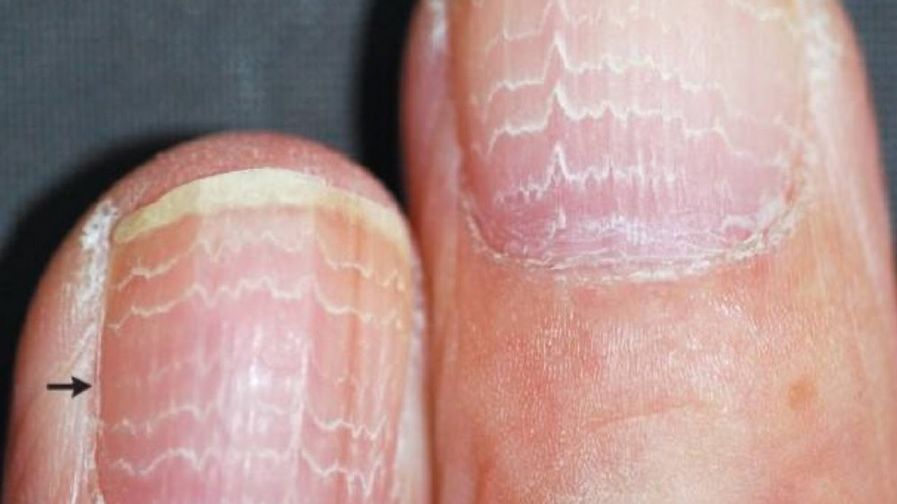 Zmiany na paznokciach mogą być reakcją na chemioterapię