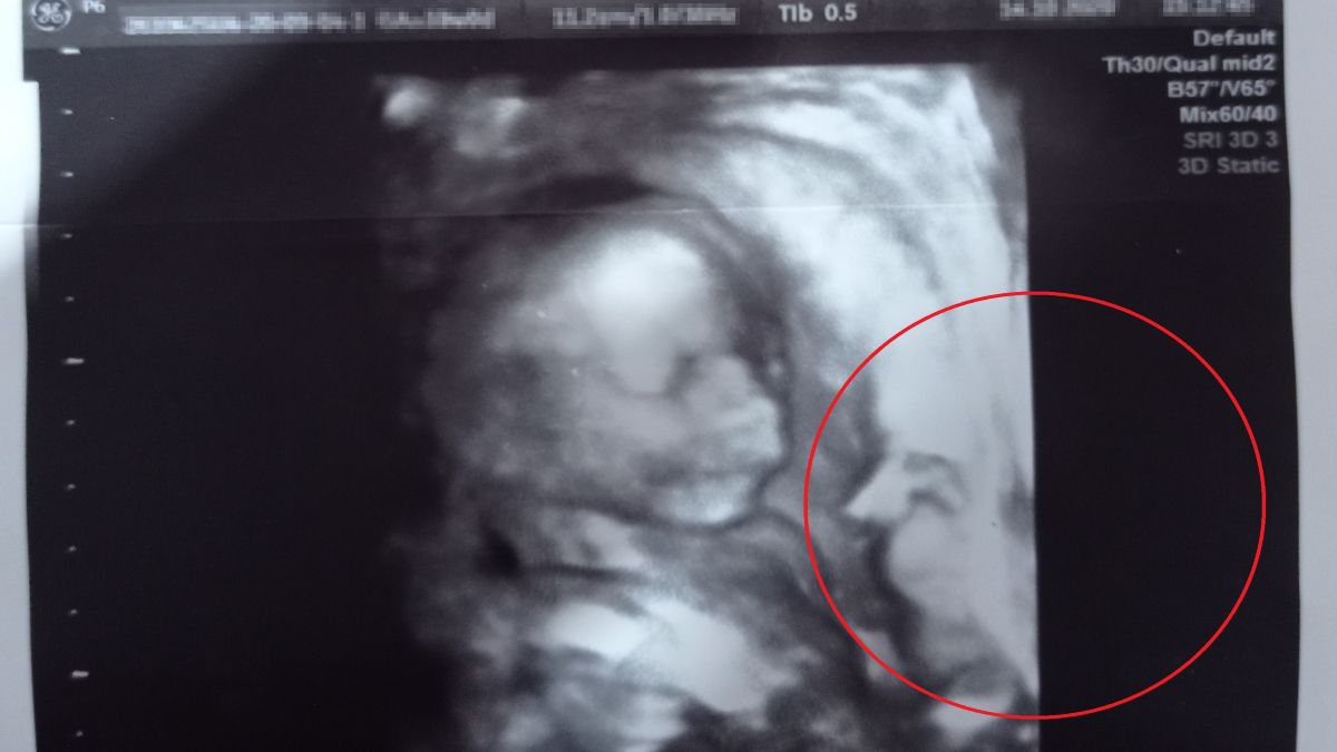 Pani Aneta podzieliła się z redakcją o2 wyjątkową pamiątką. Na zdjęciu z USG jej ciąży uchwycono nie tylko twarz maleństwa 