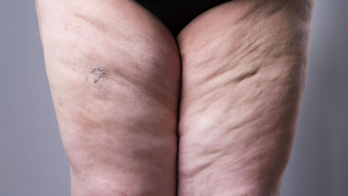 Grube nogi są skutkiem lipodemii