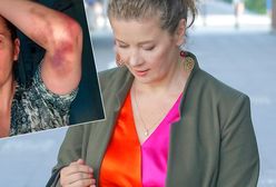Anna Powierza pokazała zdjęcia posiniaczonej ręki. "Nie lękaj się, zgłoś problem"