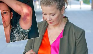 Anna Powierza pokazała zdjęcia posiniaczonej ręki. "Nie lękaj się, zgłoś problem"