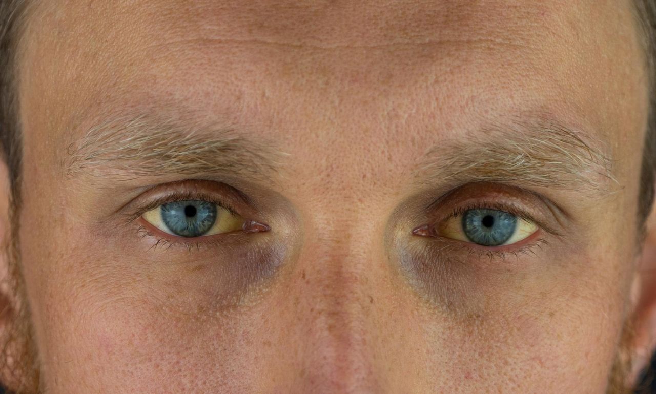 Nietypowe objawy chorej trzustki. Część widać na skórze