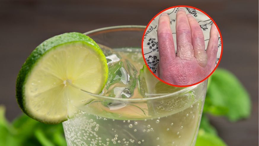 Sok z limonki spowodował rozległe poparzenia