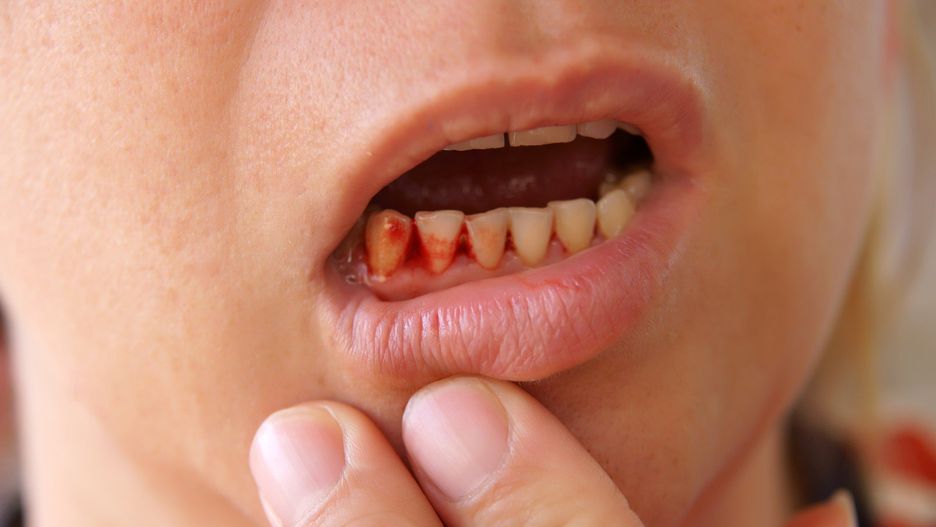 Person holding their lip down to show their bleeding gums