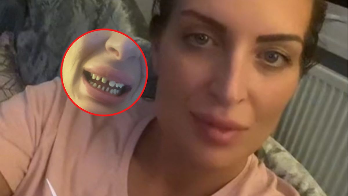 34-latka "tureckie zęby" prawie przypłaciła życiem