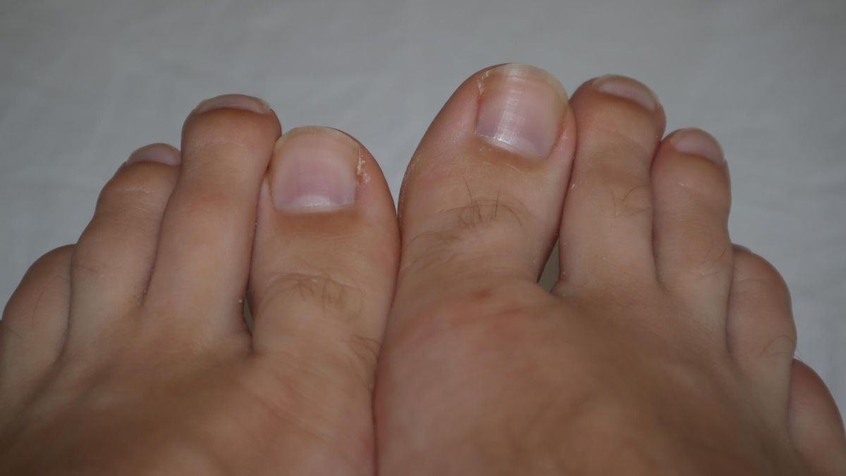 Nadmiar cholesterolu można zauważyć na paznokciu. Wiele osób myli ten objaw