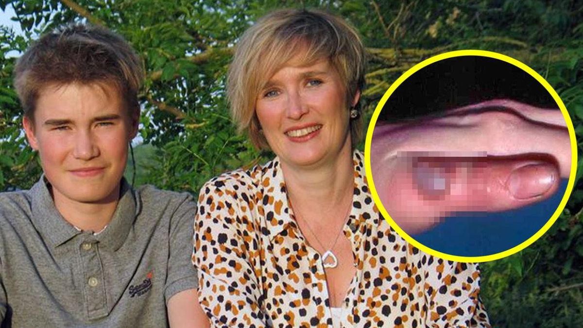 Brychan Edwards i jego mama Ffion Clwyd Edwards. W kółku efekty zarażania odzwierzęcym wirusem.