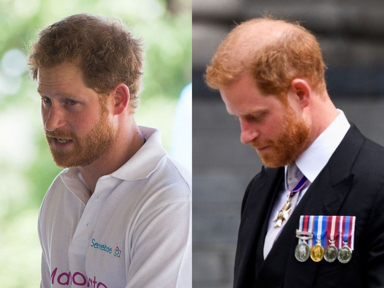 Książę Harry za dwa lata zostanie łysy?