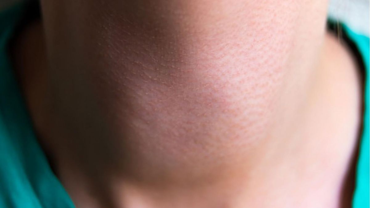 Szyja Nerona to jeden z kluczowych objawów błonicy. Czym charakteryzuje się ta choroba?