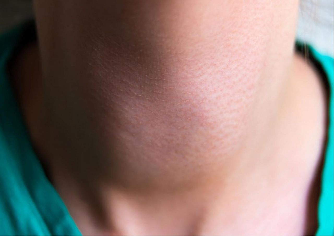 Zapomniana choroba wróciła. Szyja Nerona jest jednym z jej kluczowych objawów