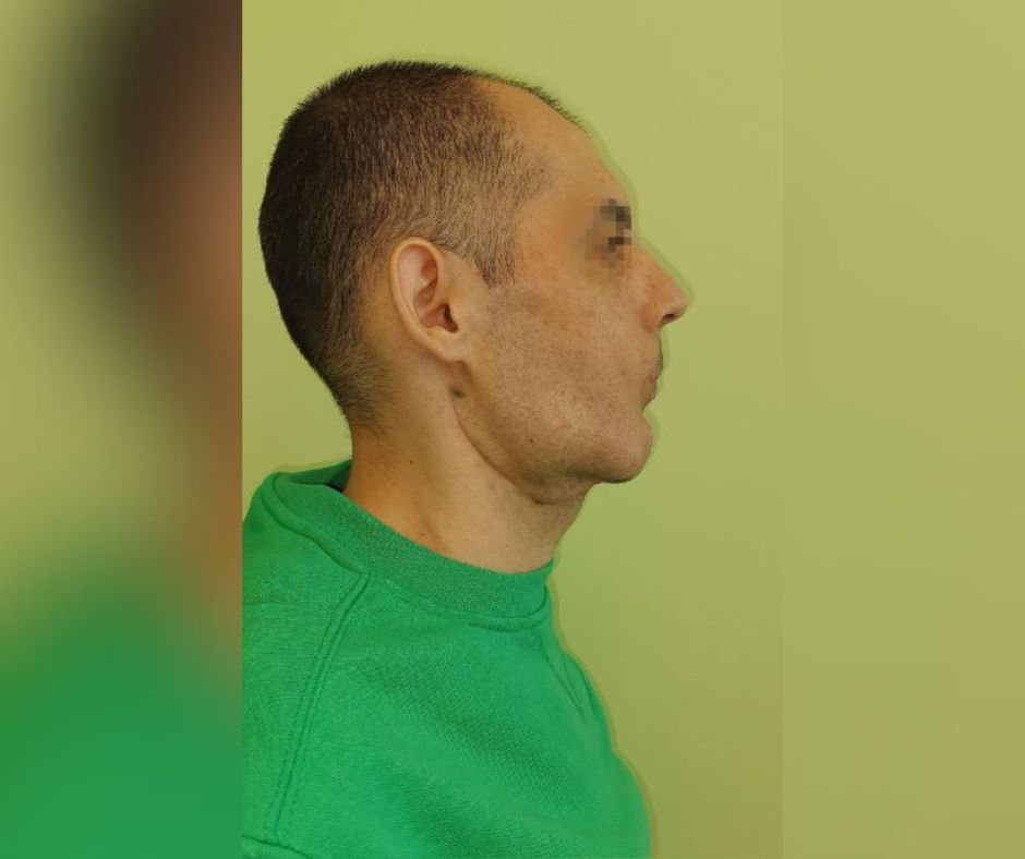 Lekarze usunęli guz z twarzy 38-latka