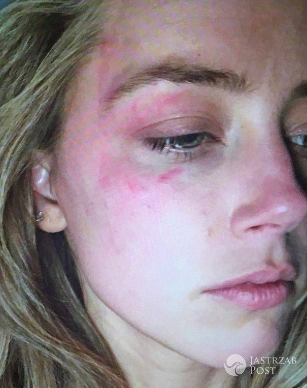 Amber Heard was beaten by Johnny Depp?