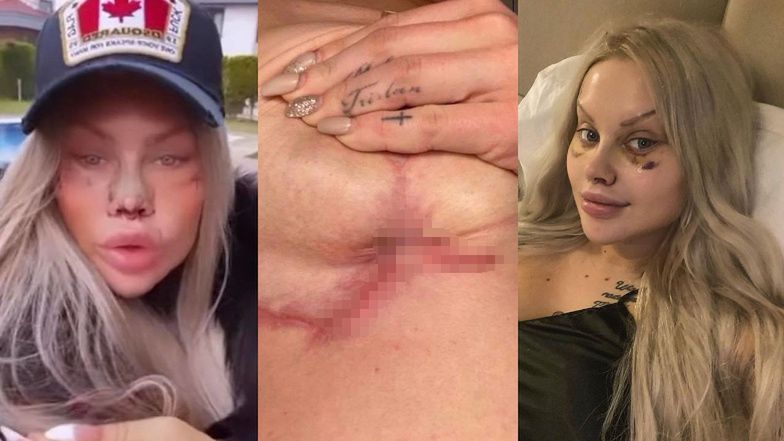 Turecka klinika Laluny Unique i Ewel0ny oskarżona o okaleczenia pacjentek