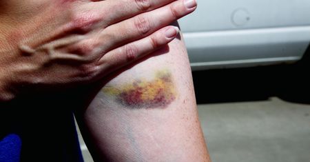 Dwa niepokojące symptomy na skórze. Mogą wskazywać na białaczkę