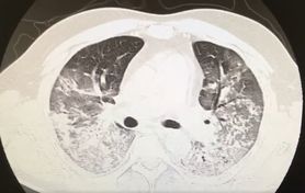 Jak wyglądają płuca 40-latka zaatakowane przez COVID?
