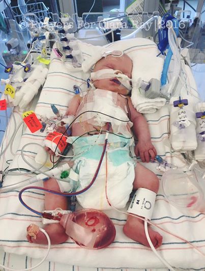 Dziewczynka urodzona z wrodzoną wadą serca/ Facebook