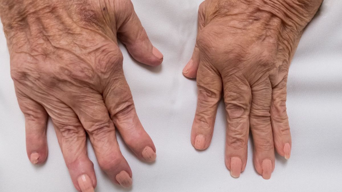 RZS dieta to specjalny sposób żywienia osób, które zmagają się z reumatoidalnym zapaleniem stawów.