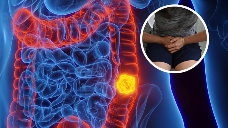 Pierwsze objawy raka jelit mogą sią pojawić do 10 lat przed diagnozą. Zwróć uwagę na te sygnały