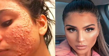 Trądzik zniszczył jej życie. Gdy się go pozbyła, została modelką